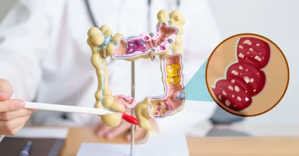 ibs-belirtileri
