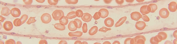 ferritin-yuksek-ama-demir-dusuk-olur-mu-fonksiyonel-demir-eksikligi-ve-inflamasyon