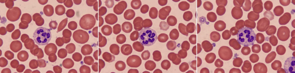 megaloblastik-anemi-nedir-folik-asit-ve-b12-eksikligiyle-iliskisi